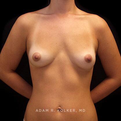 Breast Augmentation Before Image Patient 67 Front View