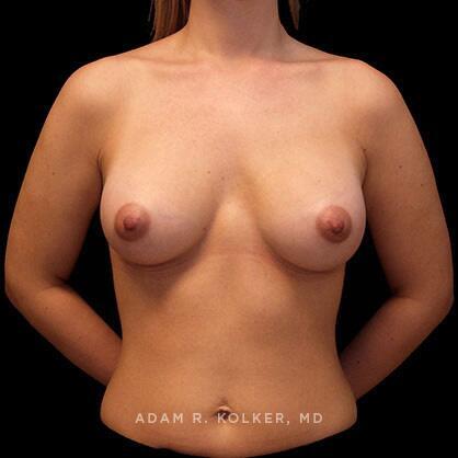 Breast Augmentation After Image Patient 67 Front View