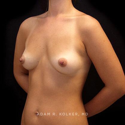 Breast Augmentation Before Image Patient 67 Oblique View