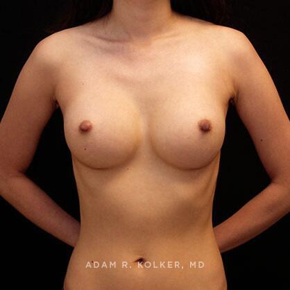 Breast Augmentation After Image Patient 68 Front View