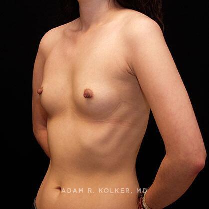 Breast Augmentation Before Image Patient 68 Oblique View
