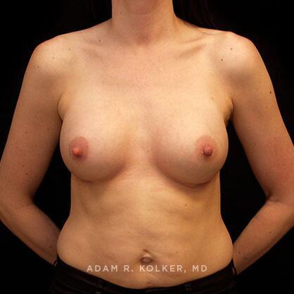 Breast Augmentation After Image Patient 70 Front View