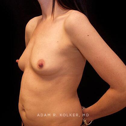 Breast Augmentation Before Image Patient 70 Oblique View