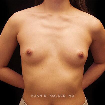 Breast Augmentation Before Image Patient 72 Front View