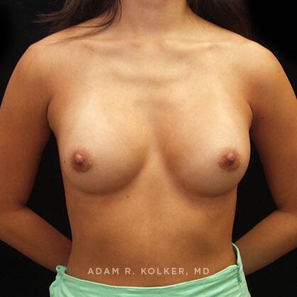 Breast Augmentation After Image Patient 72 Front View