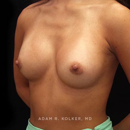 Breast Augmentation After Image Patient 72 Oblique View