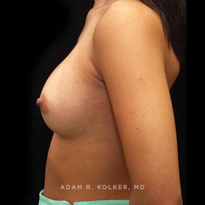 Breast Augmentation After Image Patient 72 Side View