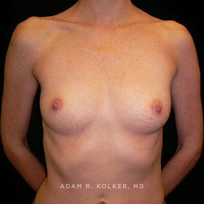 Breast Augmentation Before Image Patient 73 Front View