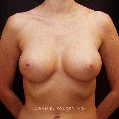 Breast Augmentation After Image Patient 73 Front View