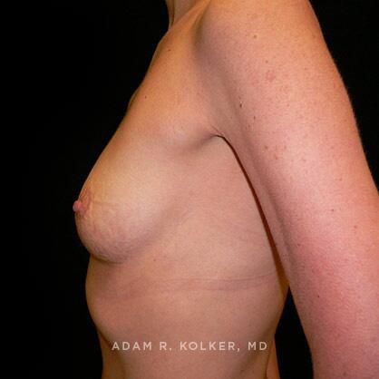 Breast Augmentation Before Image Patient 73 Side View