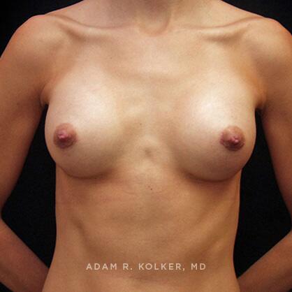 Breast Augmentation After Image Patient 74 Front View