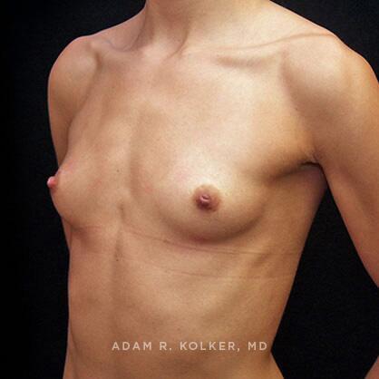 Breast Augmentation Before Image Patient 74 Oblique View