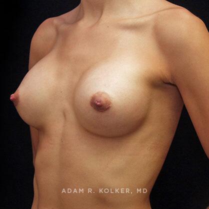 Breast Augmentation After Image Patient 74 Oblique View