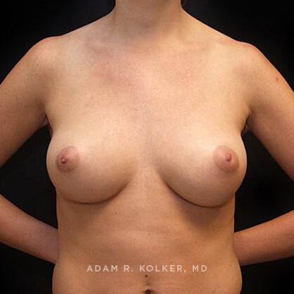 Breast Augmentation After Image Patient 75 Front View