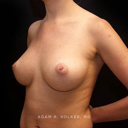 Breast Augmentation After Image Patient 75 Oblique View