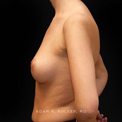 Breast Augmentation Before Image Patient 75 Side View