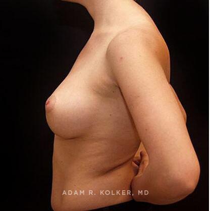 Breast Augmentation After Image Patient 75 Side View