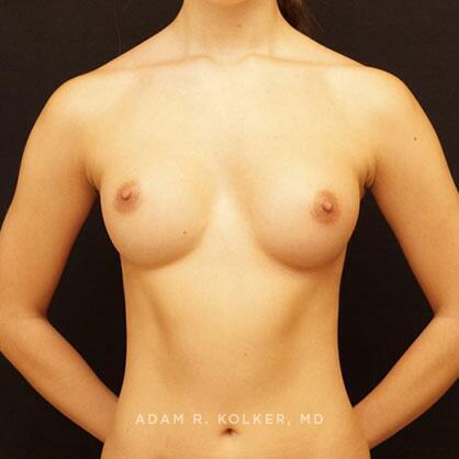 Breast Augmentation After Image Patient 76 Front View