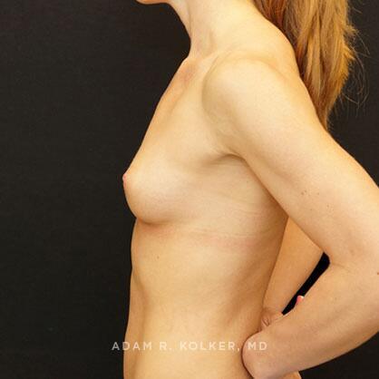 Breast Augmentation Before Image Patient 77 Side View