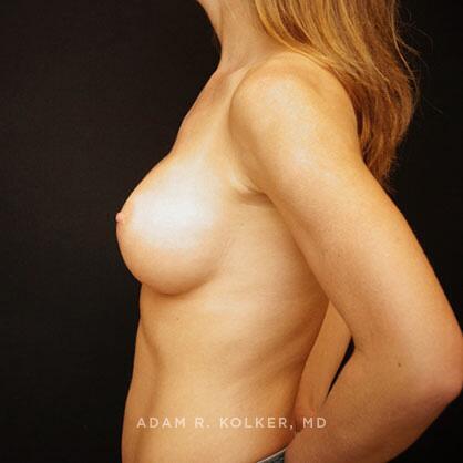 Breast Augmentation After Image Patient 77 Side View