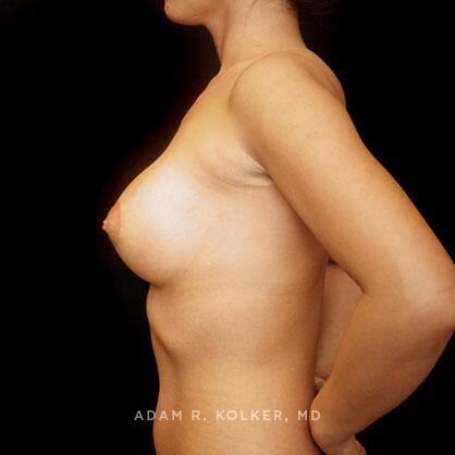 Breast Augmentation After Image Patient 78 Side View