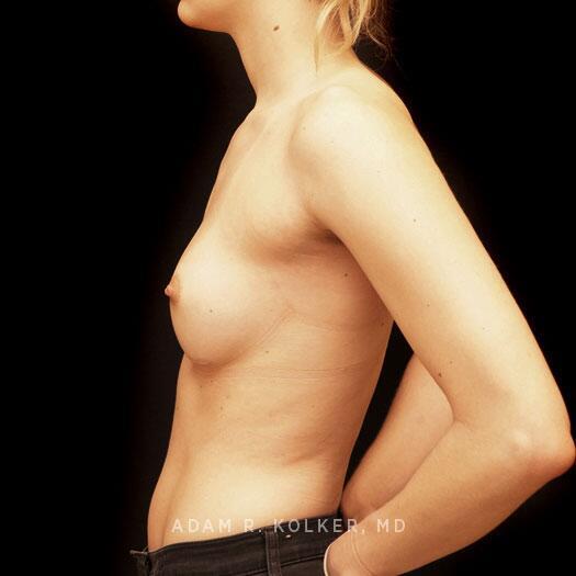 Breast Augmentation After Image Patient 80 Side View