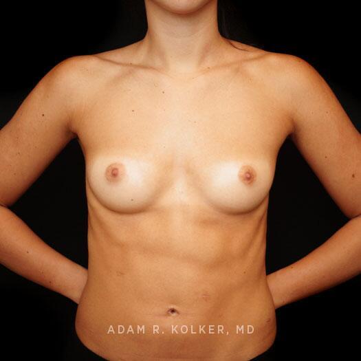 Breast Augmentation Before Image Patient 82 Front View