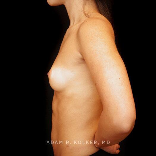 Breast Augmentation After Image Patient 82 Side View