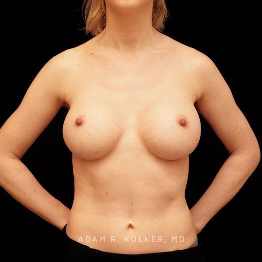 Breast Augmentation After Image Patient 85 Front View