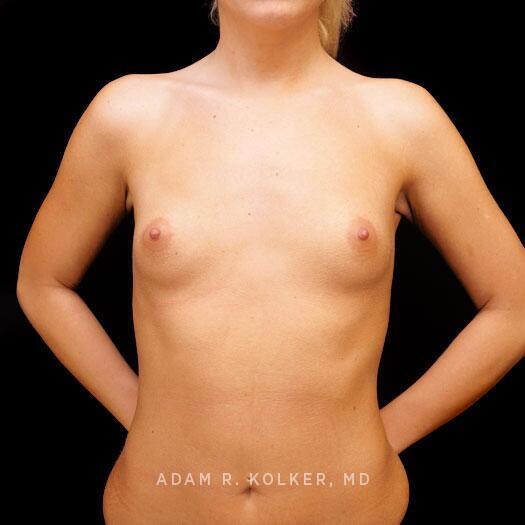 Breast Augmentation Before Image Patient 87 Front View
