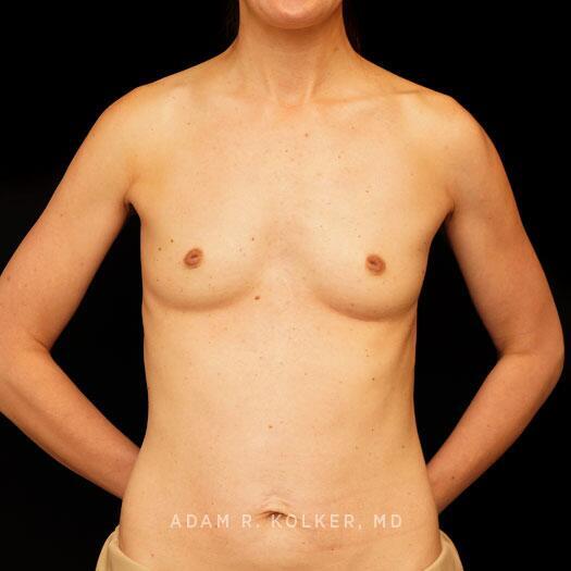 Breast Augmentation After Image Patient 88 Front View