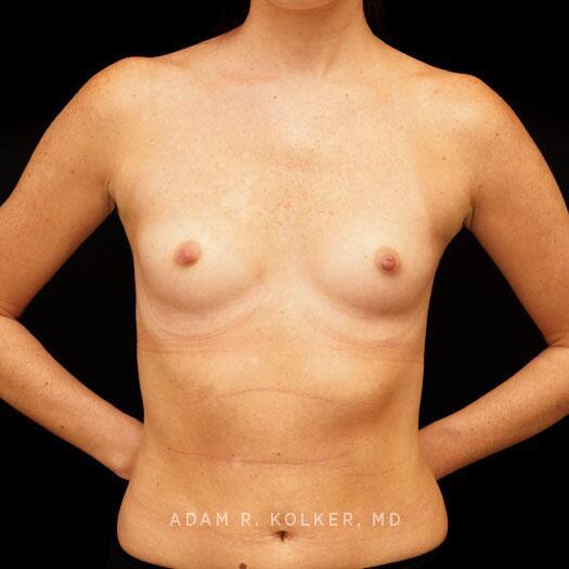 Breast Augmentation Before Image Patient 91 Front View