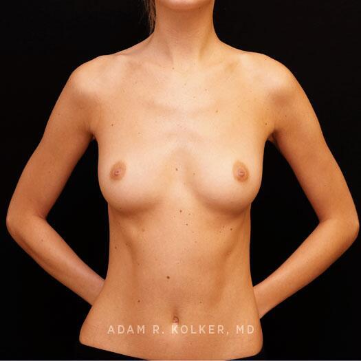 Breast Augmentation Before Image Patient 93 Front View