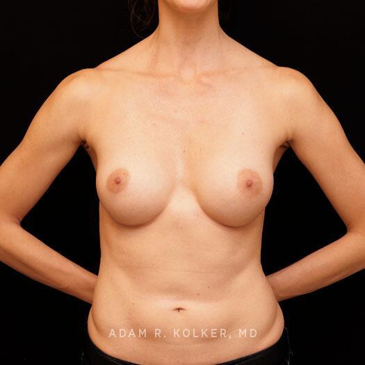 Breast Augmentation After Image Patient 95 Front View
