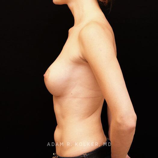 Breast Augmentation After Image Patient 95 Side View
