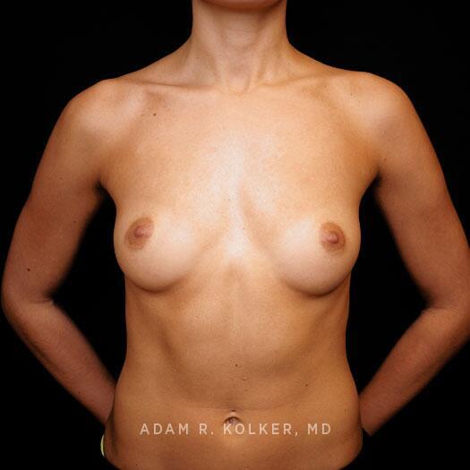 Breast Augmentation After Image Patient 97 Front View