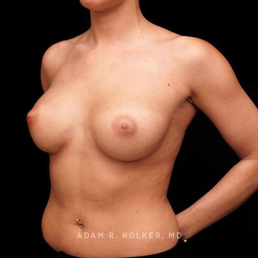Breast Augmentation After Image Patient 98 Oblique View