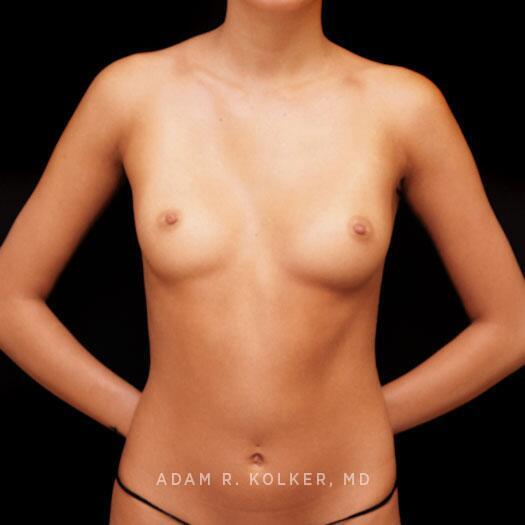 Breast Augmentation After Image Patient 99 Front View