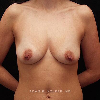 Breast Lift Before Image Patient 04 Front View