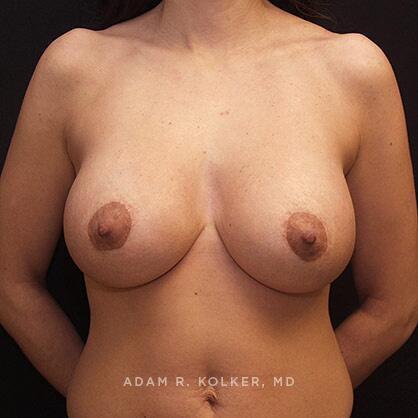 Breast Lift After Image Patient 04 Front View