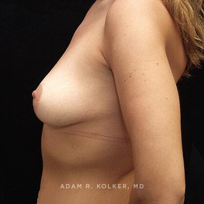 Breast Lift After Image Patient 07 Side View