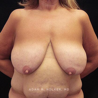 Breast Lift Before Image Patient 10 Front View
