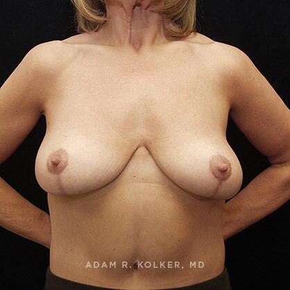 Breast Lift After Image Patient 10 Front View