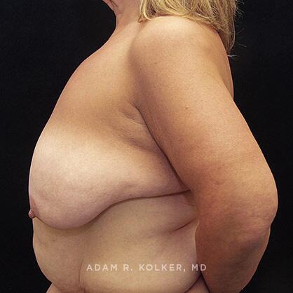 Breast Lift Before Image Patient 10 Side View