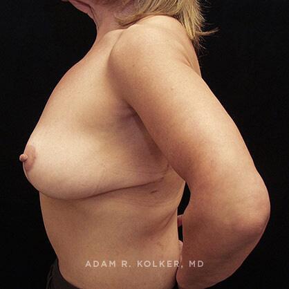 Breast Lift After Image Patient 10 Side View