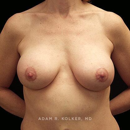 Breast Lift After Image Patient 12 Front View