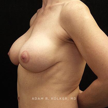 Breast Lift After Image Patient 12 Oblique View