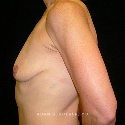 Breast Lift Before Image Patient 12 Side View