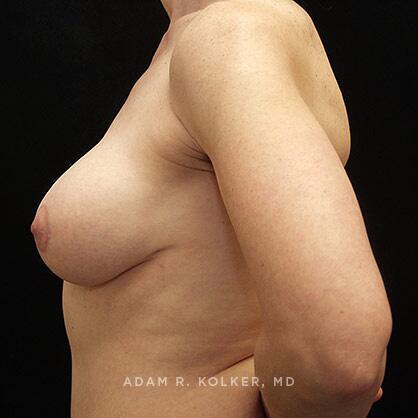 Breast Lift After Image Patient 12 Side View