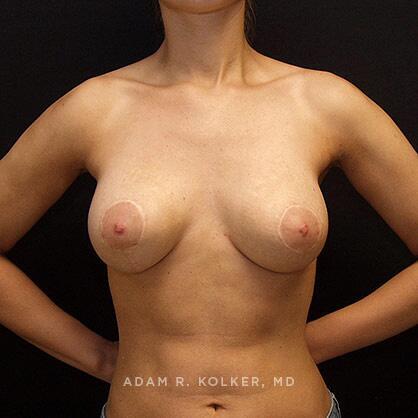 Breast Lift After Image Patient 13 Front View